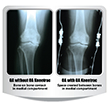 KneeTrac X-Rays